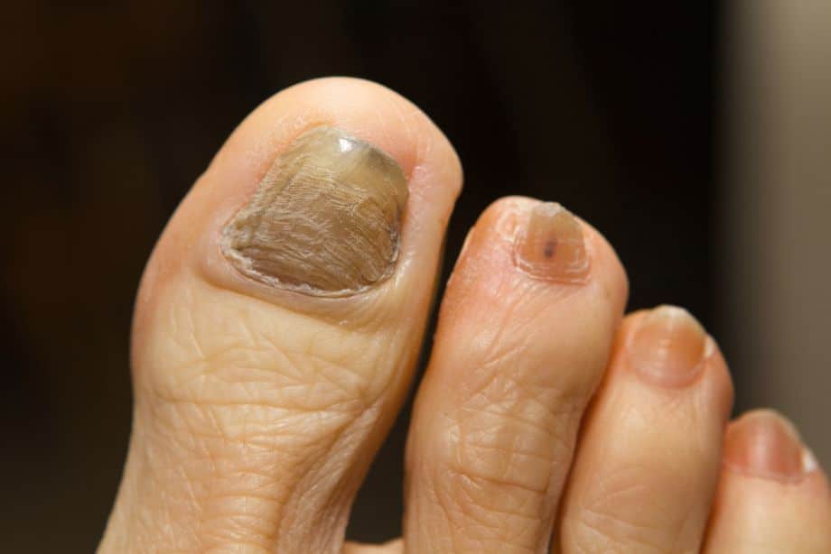 Mycose de l’ongle du pied : traitements sans ordonnance, du naturel au laser