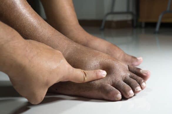 Comment faire dégonfler les pieds rapidement et naturellement ?