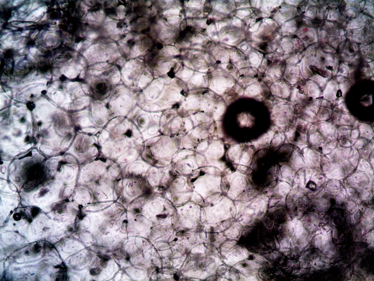 Vue microscopique de la muqueuse œsophagienne irritée par l'acide gastrique